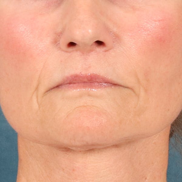 Lip Lift Before & After Gallery - Patient 414906 - Image 2