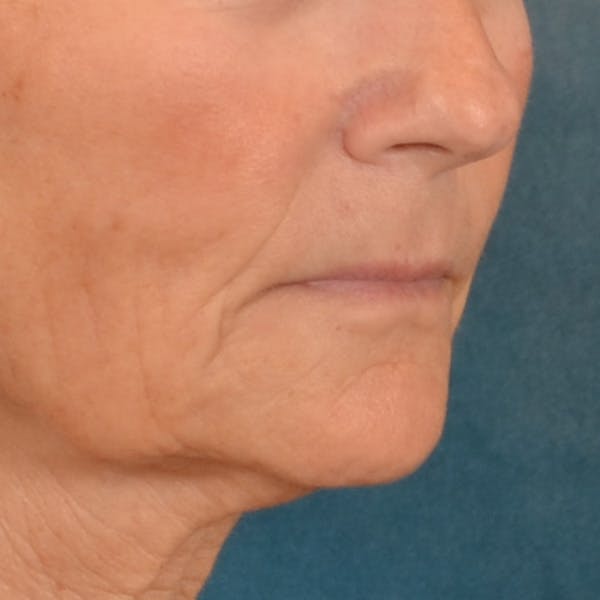 Lip Lift Before & After Gallery - Patient 414906 - Image 3
