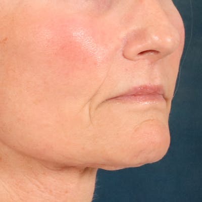 Lip Lift Before & After Gallery - Patient 414906 - Image 4