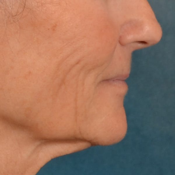 Lip Lift Before & After Gallery - Patient 414906 - Image 5