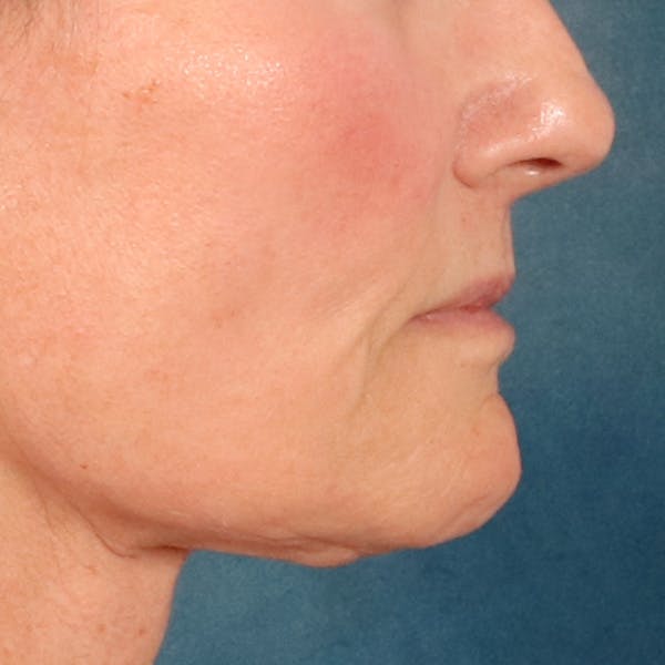 Lip Lift Before & After Gallery - Patient 414906 - Image 6