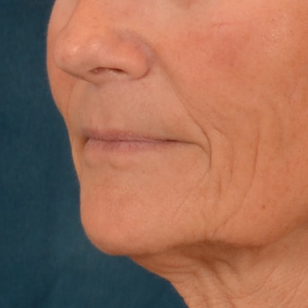 Lip Lift Before & After Gallery - Patient 414906 - Image 7
