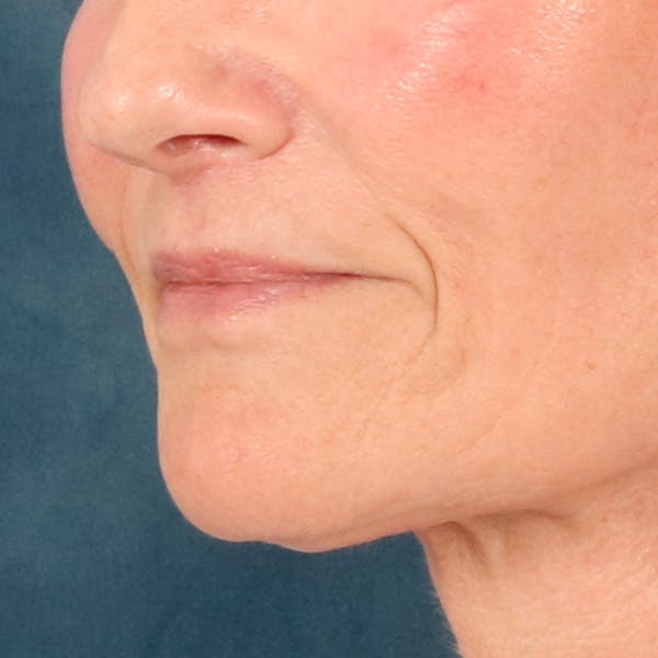 Lip Lift Before & After Gallery - Patient 414906 - Image 8