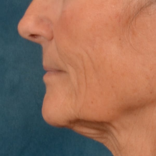 Lip Lift Before & After Gallery - Patient 414906 - Image 9