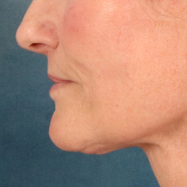 Lip Lift Before & After Gallery - Patient 414906 - Image 10