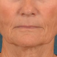 Lip Lift Before & After Gallery - Patient 414906 - Image 1
