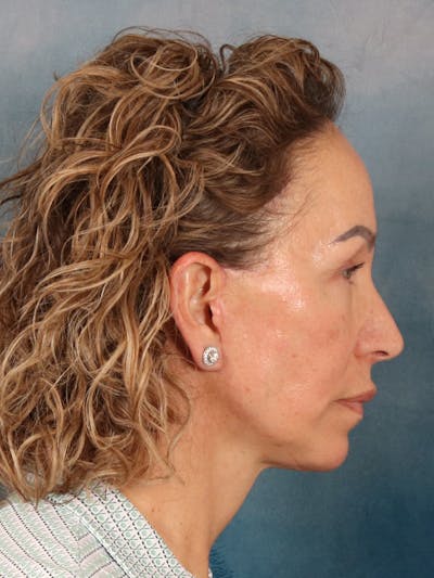 Fat Transfer Before & After Gallery - Patient 404800 - Image 8