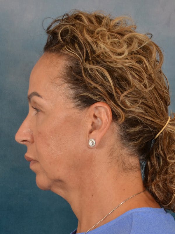 Fat Transfer Before & After Gallery - Patient 404800 - Image 9