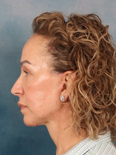 Fat Transfer Before & After Gallery - Patient 404800 - Image 10