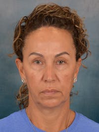 Fat Transfer Before & After Gallery - Patient 404800 - Image 1