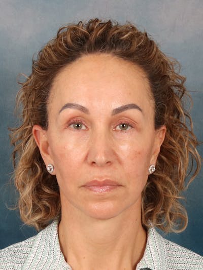 Fat Transfer Before & After Gallery - Patient 404800 - Image 2