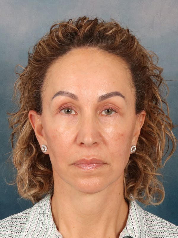 Fat Transfer Before & After Gallery - Patient 404800 - Image 2