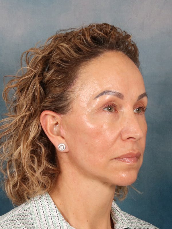 Fat Transfer Before & After Gallery - Patient 404800 - Image 5