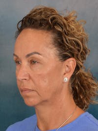Deep Plane Facelift Before & After Gallery - Patient 148969 - Image 1