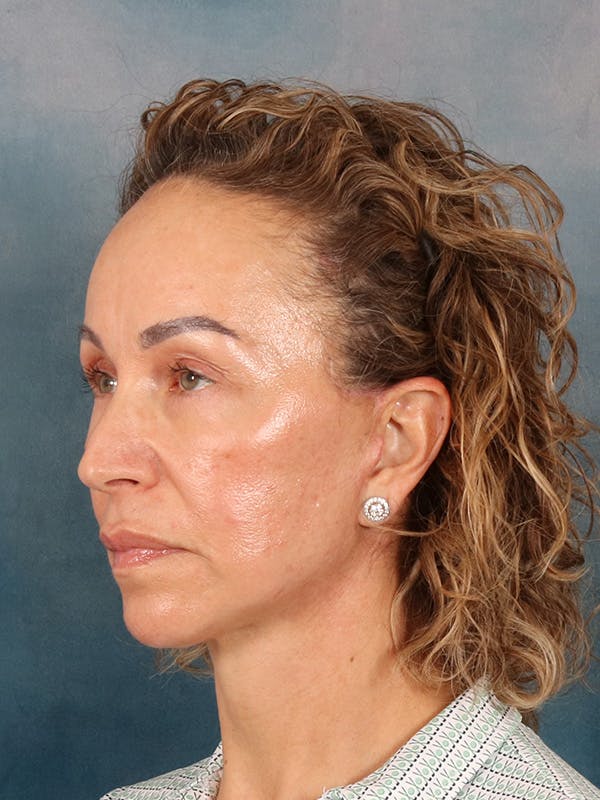 Fat Transfer Before & After Gallery - Patient 404800 - Image 4