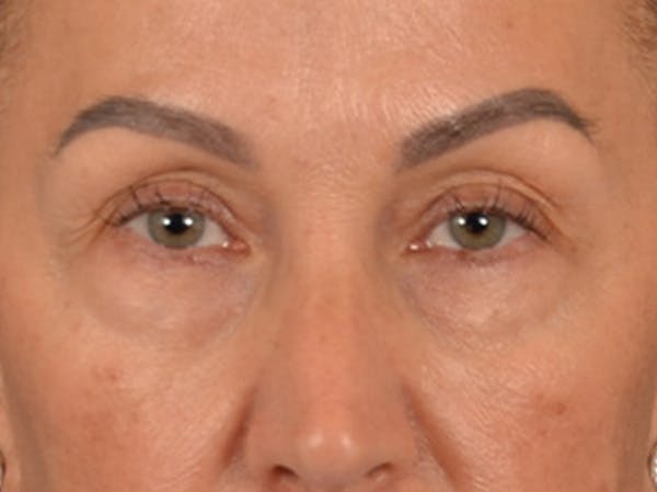 Eyelid Lift Before & After Gallery - Patient 350236 - Image 1