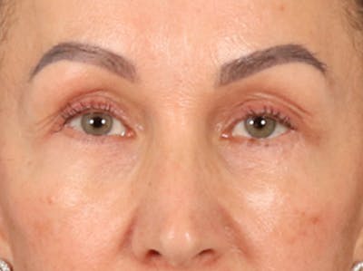 Eyelid Lift Before & After Gallery - Patient 350236 - Image 2