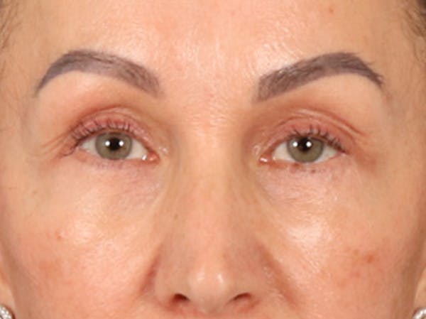 Eyelid Lift Before & After Gallery - Patient 350236 - Image 2