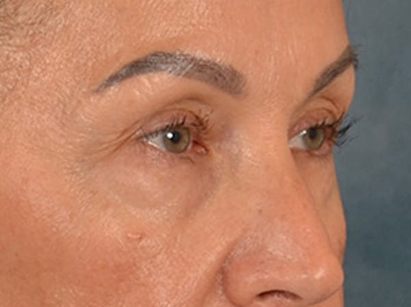 Eyelid Lift Before & After Gallery - Patient 350236 - Image 3