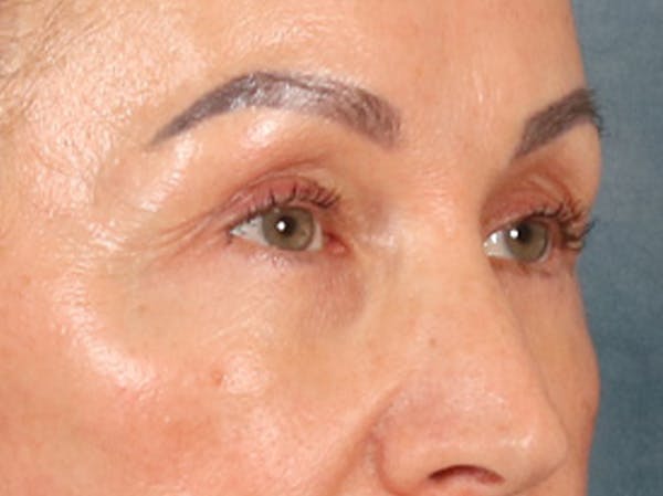 Eyelid Lift Before & After Gallery - Patient 350236 - Image 4
