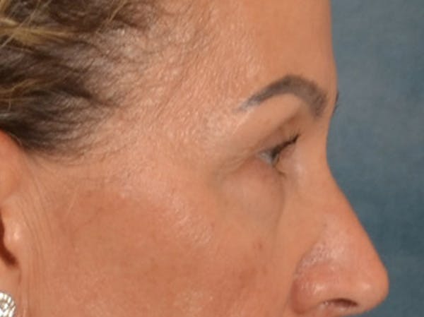 Eyelid Lift Before & After Gallery - Patient 350236 - Image 5