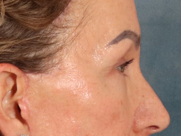 Eyelid Lift Before & After Gallery - Patient 350236 - Image 6