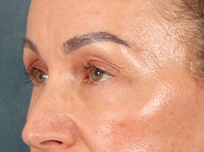 Eyelid Lift Before & After Gallery - Patient 350236 - Image 8