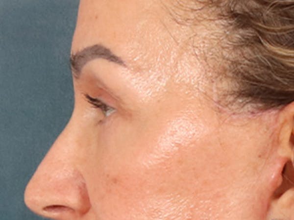 Eyelid Lift Before & After Gallery - Patient 350236 - Image 10