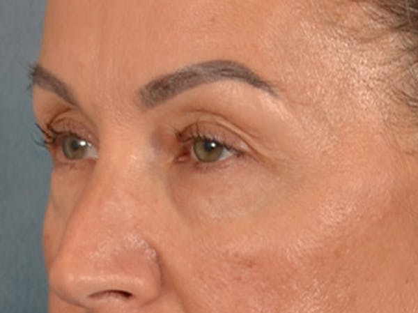 Eyelid Lift Before & After Gallery - Patient 350236 - Image 7