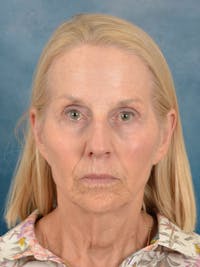 Deep Neck Lift Before & After Gallery - Patient 309301 - Image 1