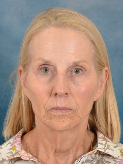Laser Skin Resurfacing Before & After Gallery - Patient 208298 - Image 1