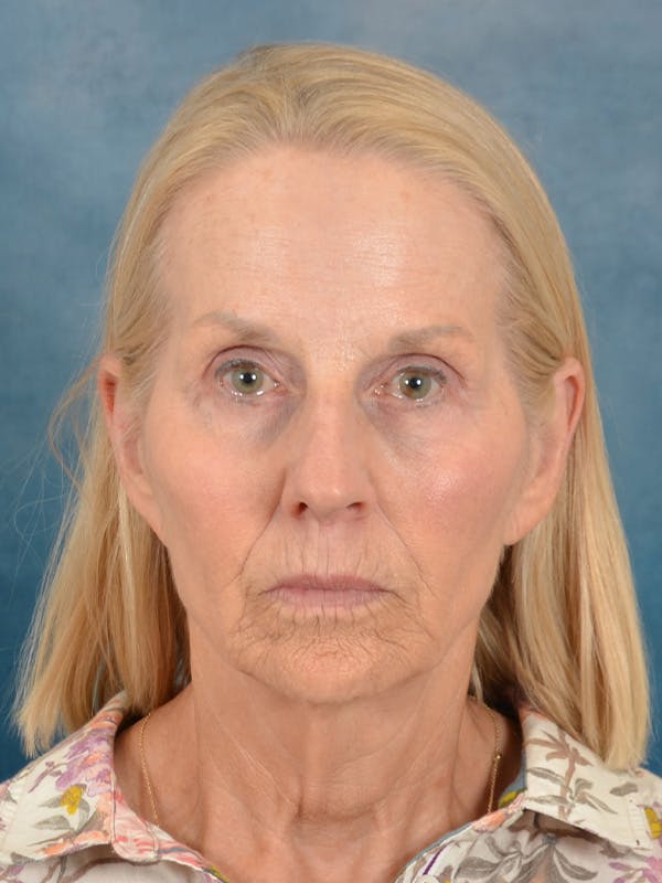 Deep Neck Lift Before & After Gallery - Patient 309301 - Image 1