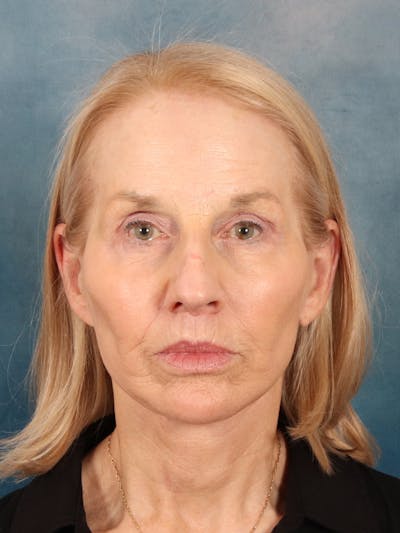 Deep Neck Lift Before & After Gallery - Patient 309301 - Image 2