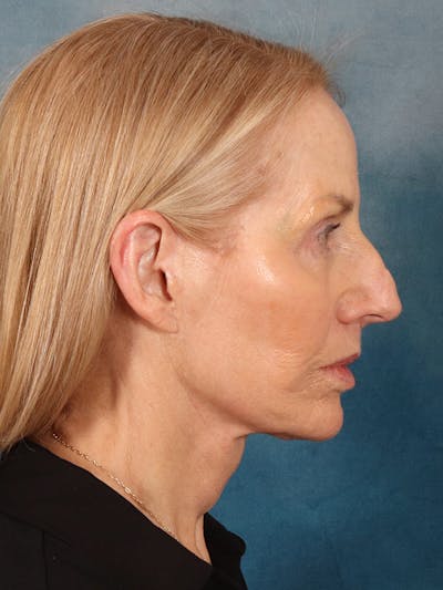 Deep Neck Lift Before & After Gallery - Patient 309301 - Image 10