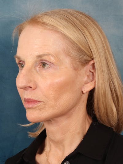 Deep Neck Lift Before & After Gallery - Patient 309301 - Image 4