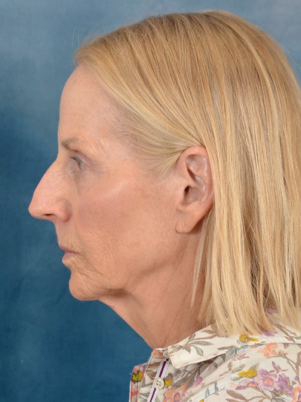Deep Neck Lift Before & After Gallery - Patient 309301 - Image 5