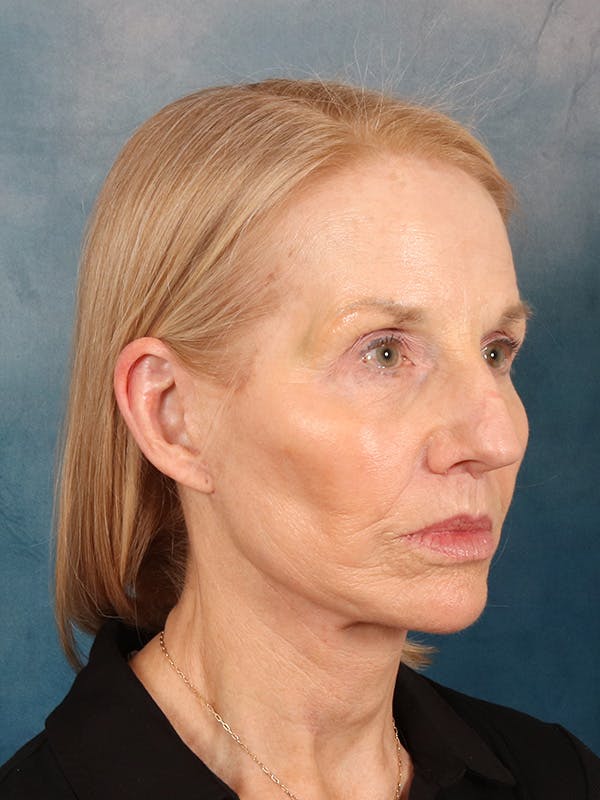 Deep Neck Lift Before & After Gallery - Patient 309301 - Image 8