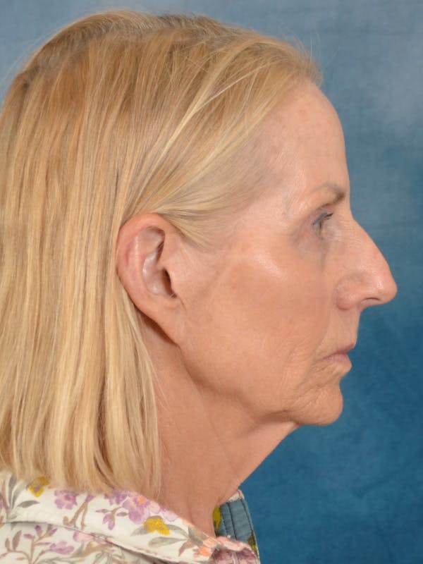 Deep Neck Lift Before & After Gallery - Patient 309301 - Image 9
