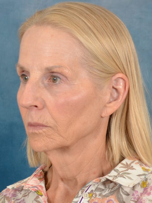 Deep Neck Lift Before & After Gallery - Patient 309301 - Image 3