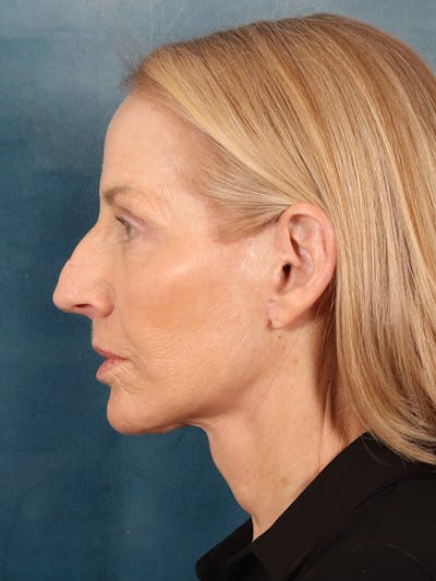 Deep Neck Lift Before & After Gallery - Patient 309301 - Image 6