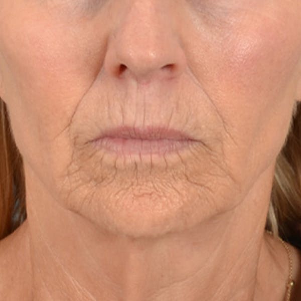 Lip Lift Before & After Gallery - Patient 114809 - Image 1