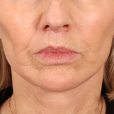 Lip Lift Before & After Gallery - Patient 114809 - Image 2