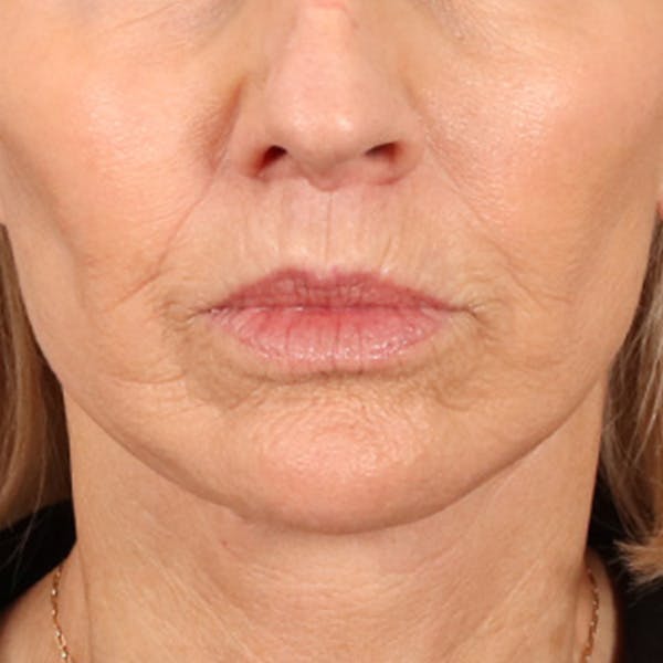 Lip Lift Before & After Gallery - Patient 114809 - Image 2
