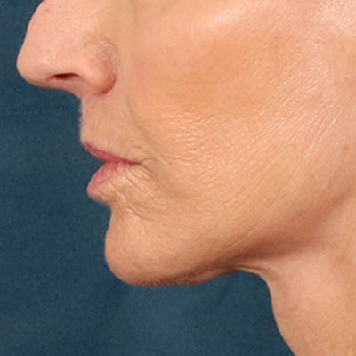 Lip Lift Before & After Gallery - Patient 114809 - Image 10