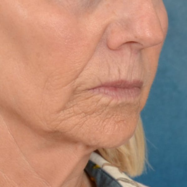 Lip Lift Before & After Gallery - Patient 114809 - Image 3