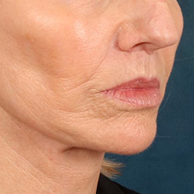 Lip Lift Before & After Gallery - Patient 114809 - Image 4