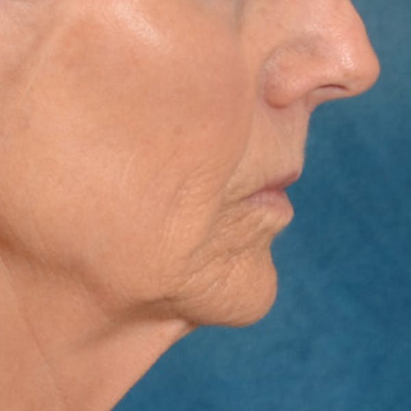 Lip Lift Before & After Gallery - Patient 114809 - Image 5