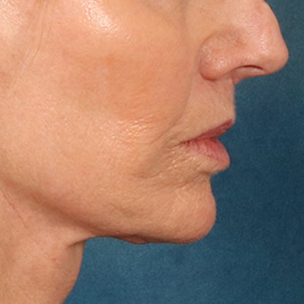 Lip Lift Before & After Gallery - Patient 114809 - Image 6