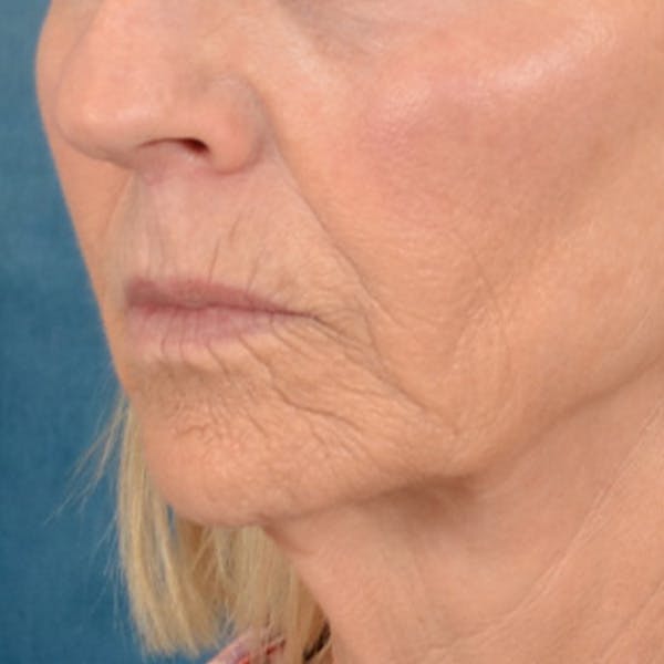Lip Lift Before & After Gallery - Patient 114809 - Image 7