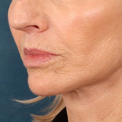 Lip Lift Before & After Gallery - Patient 114809 - Image 8